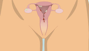 wow-l2-postmenopausal-bleeding-id10067-02.jpg